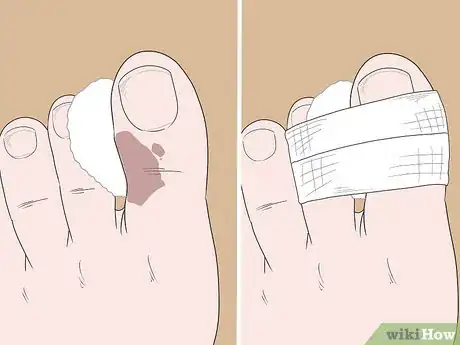 Image titled Heal a Bruised Toe Step 5