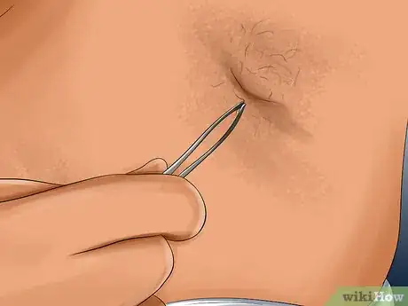 Image titled Prevent Ingrown Hairs on the Pubic Area Step 11