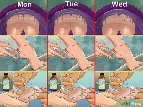 Image titled Pumice a Wart Step 4