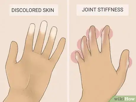 Image titled Treat Scleroderma Step 5