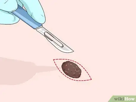 Image titled Undergo a Mole Biopsy Step 4