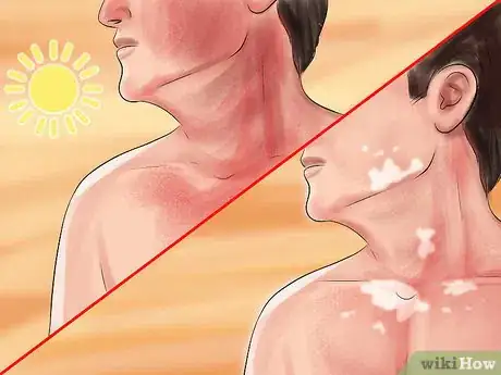 Image titled Diagnose Vitiligo Step 4