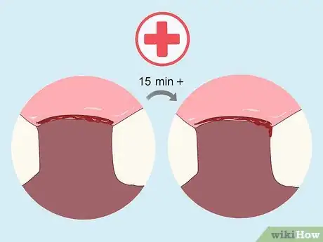 Image titled Pull a Loose Tooth at Home Step 13