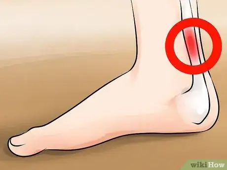 Image titled Recognize Plantar Fasciitis Symptoms Step 4