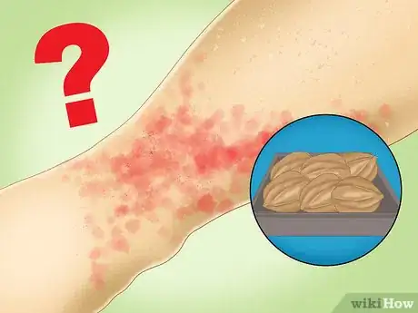 Image titled Prevent Hives Step 11