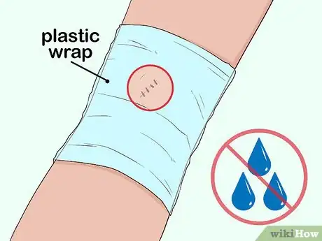 Image titled Undergo a Mole Biopsy Step 8