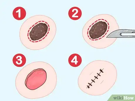 Image titled Undergo a Mole Biopsy Step 3