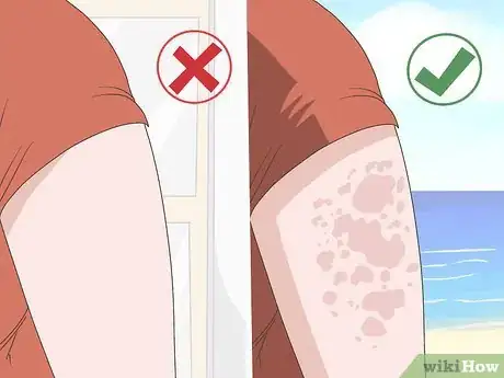 Image titled Avoid Triggers for Chronic Hives Step 4