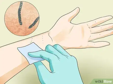 Image titled Recognize Scabies Rash Step 7