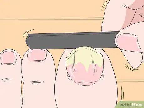 Image titled Trim Toenails with Fungus Step 5
