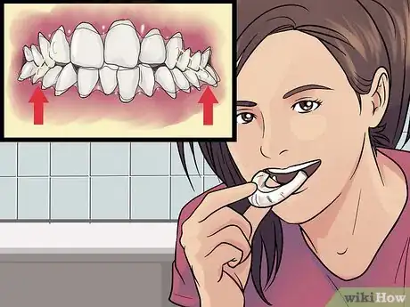 Image titled Get Straight Teeth Without Braces with Invisalign Step 9