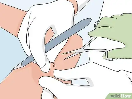 Image titled Remove Nexplanon Step 5