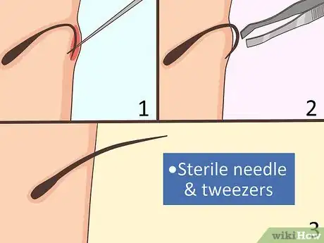 Image titled Remove an Ingrown Hair Step 7