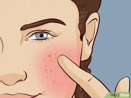 Image titled What Causes Skin to Be Sensitive Step 1