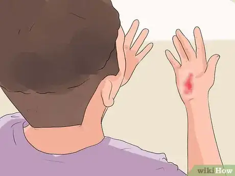 Image titled Remove Fiberglass Slivers from Your Skin Step 14