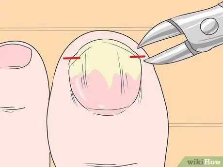 Image titled Trim Toenails with Fungus Step 4