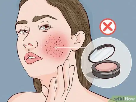 Image titled What Causes Skin to Be Sensitive Step 3