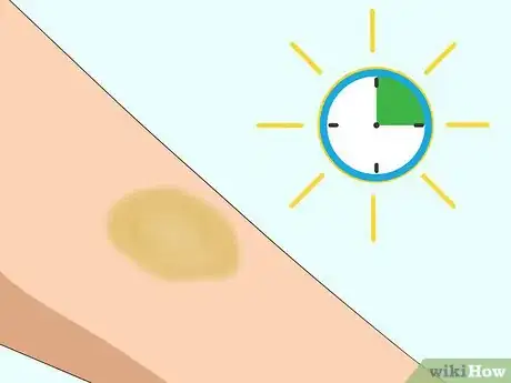 Image titled Make a Bruise Go Away Faster Step 6