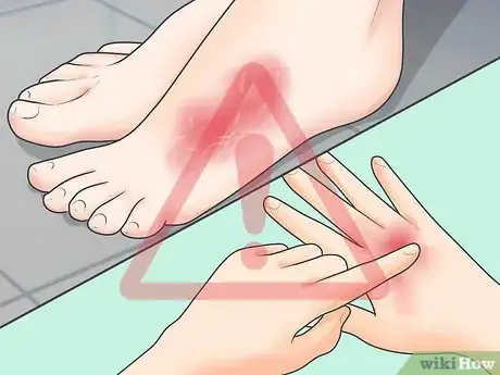 Image titled Know if You Have Toxic Shock Syndrome Step 2