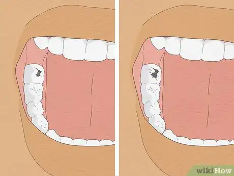 Image titled Treat Cavities Step 2