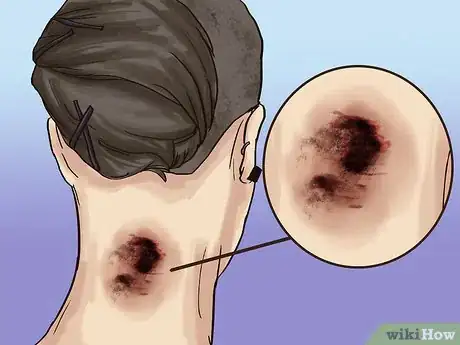 Image titled Care for a Tattoo During Removal Step 6