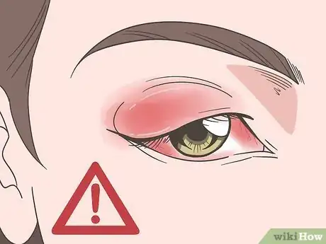 Image titled Manage Eye Disorders with Crohn's Disease Step 6