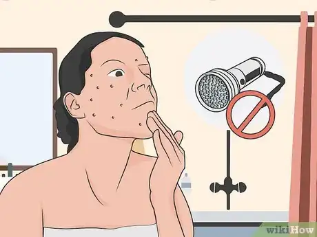 Image titled Use Blue Light Acne Treatment Step 10