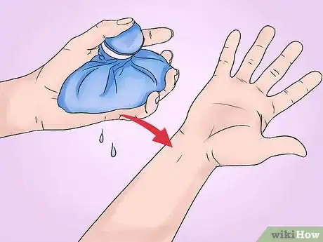 Image titled Reduce Symptoms of Carpal Tunnel During Pregnancy Step 1