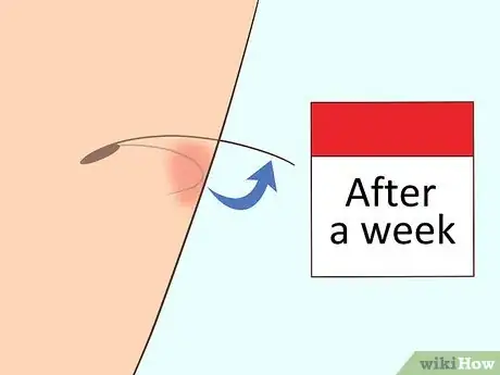 Image titled Remove an Ingrown Hair Step 1