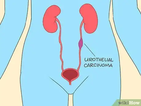 Image titled Treat Bladder Cancer Step 1