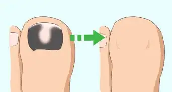 Treat a Black Toenail