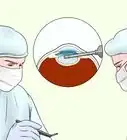 Prevent Development of Cataracts