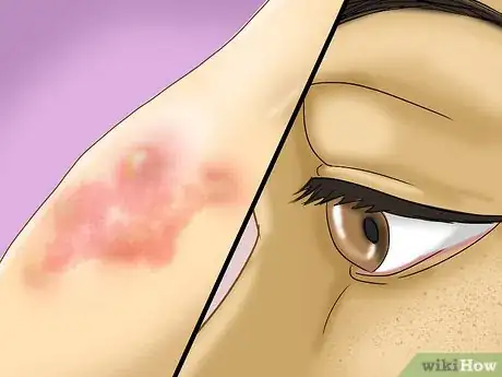 Image titled Treat Vibration Induced Hives Step 8