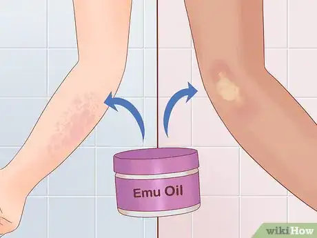 Image titled Use Emu Oil for Health and Skin Benefits Step 6