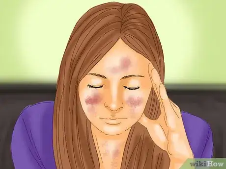 Image titled Diagnose Typhoid Fever Step 2