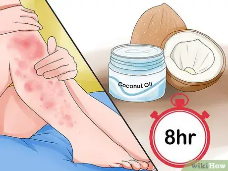 Image titled Choose a Moisturizer for Psoriasis Step 5