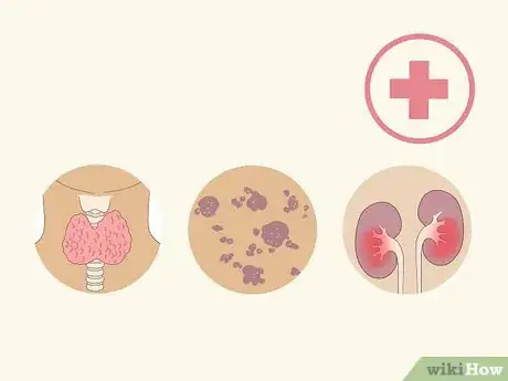 Image titled Control Uric Acid in the Body Step 15