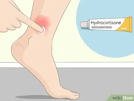 Image titled Soothe Itchy Legs Step 31