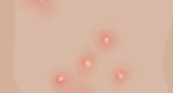 Get Rid of Fordyce Spots