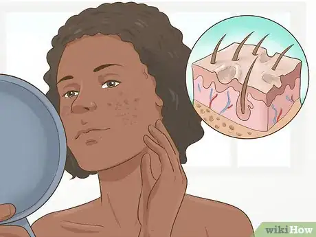 Image titled Know if You Need a Prescription Acne Treatment Step 4