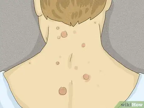 Image titled Test for Nongenital STIs Step 1