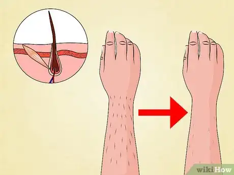 Image titled Get the Most Benefit from Laser Hair Removal Step 11