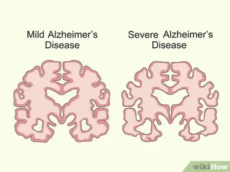 Image titled Treat Neurological Disorders Step 23