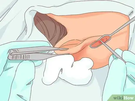 Image titled Treat an Infected Ear Piercing Step 6