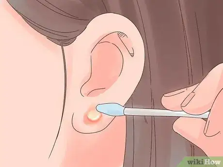 Image titled Treat an Infected Ear Piercing Step 8