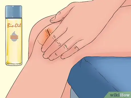 Image titled Use Bio Oil Step 2