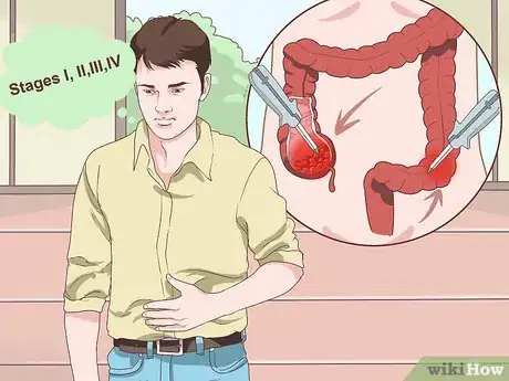 Image titled Treat Colon Cancer Step 1