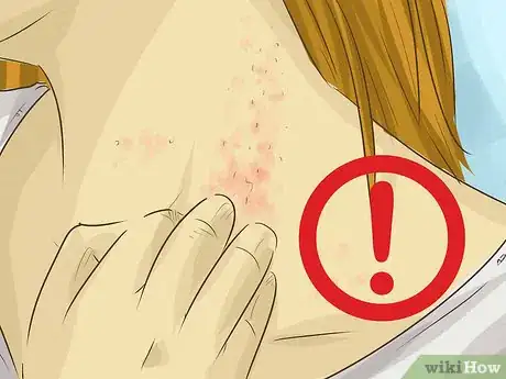 Image titled Live With an Allergy to Seafood Step 14