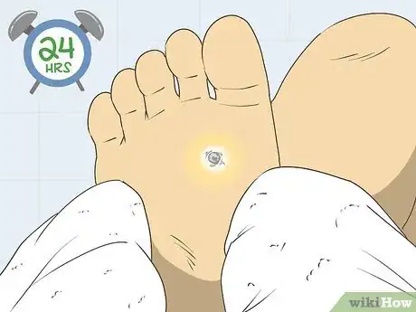 Image titled Freeze Plantar Warts Step 10