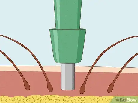 Image titled Determine the Cause of Hair Loss Step 6